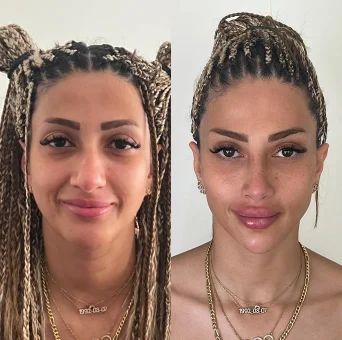Before and After: Non-surgical facial redesign and contouring using the Picasso Technique by Dr. Farzan Malekzadeh Picasso Technique – Natural Face Contouring & Asymmetry Correction (No Surgery)