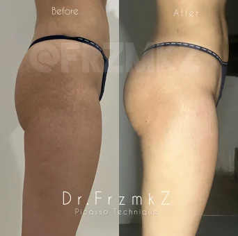Before and After: Body contouring using the exclusive Picasso Technique (BBL + V Technique) with specialized PT filler by Dr. Farzan Malekzadeh BBL & V-Contouring with Picasso Technique – Buttock Transformation