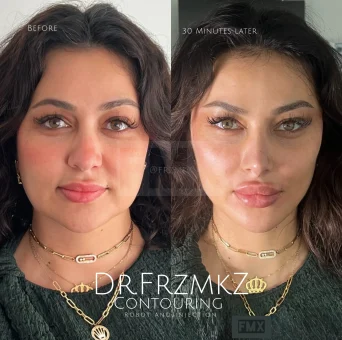 Before and After: Advanced non-surgical facial contouring using the Picasso Technique by Dr. Farzan Malekzadeh img 8270